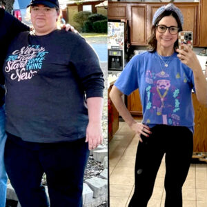 gastric sleeve before and after female​