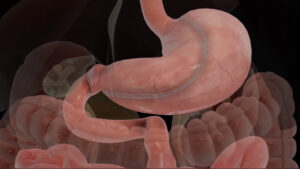 advantages of bariatric weight loss surgery