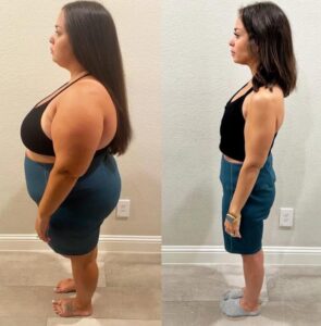 RNY before and after pictures - Patient lost 98 lbs in 12 months