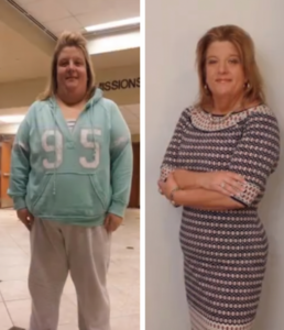 before and after gastric sleeve women​
