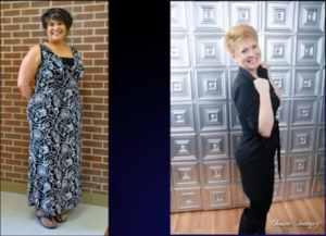 gastric bypass before and after female