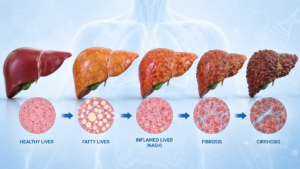 mash liver disease