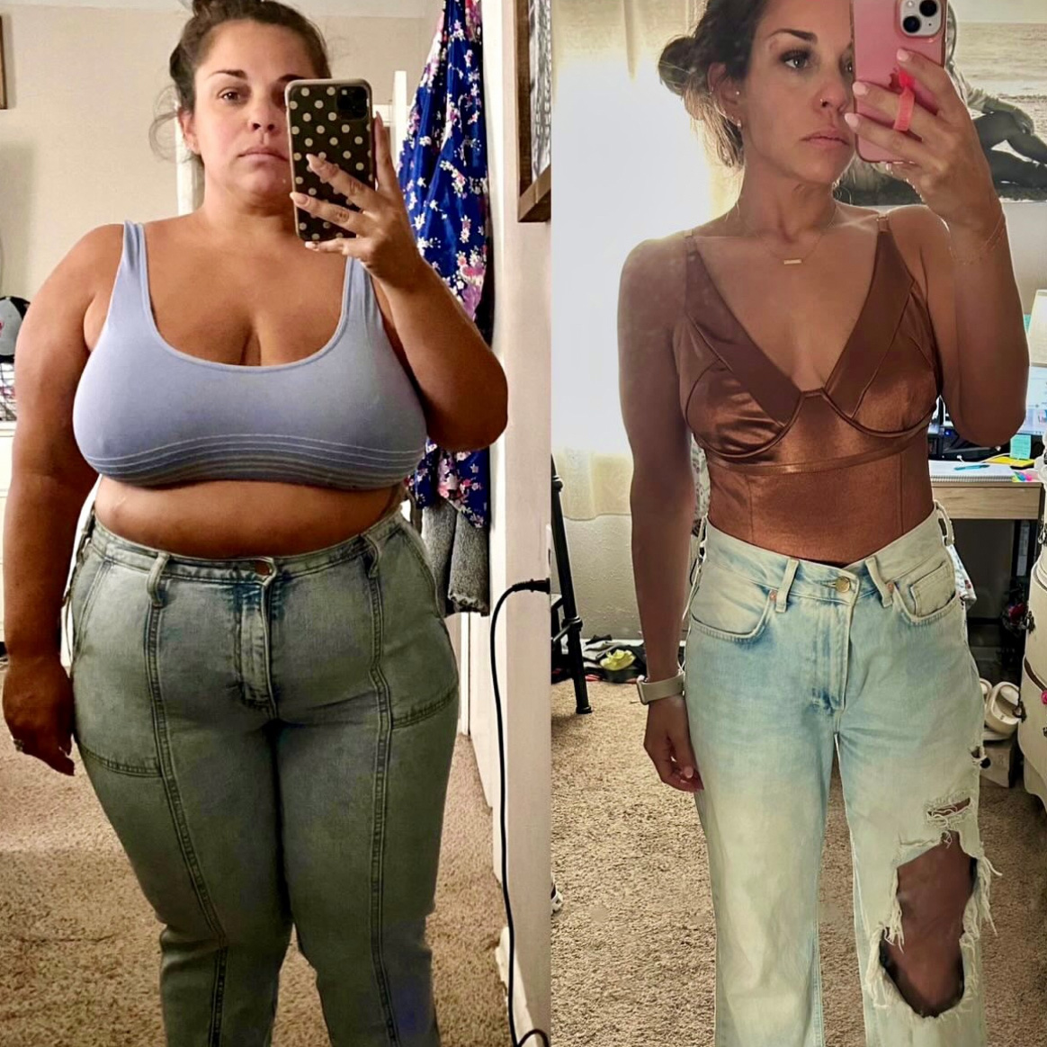 BodEvolve patient before and after bariatric treatment