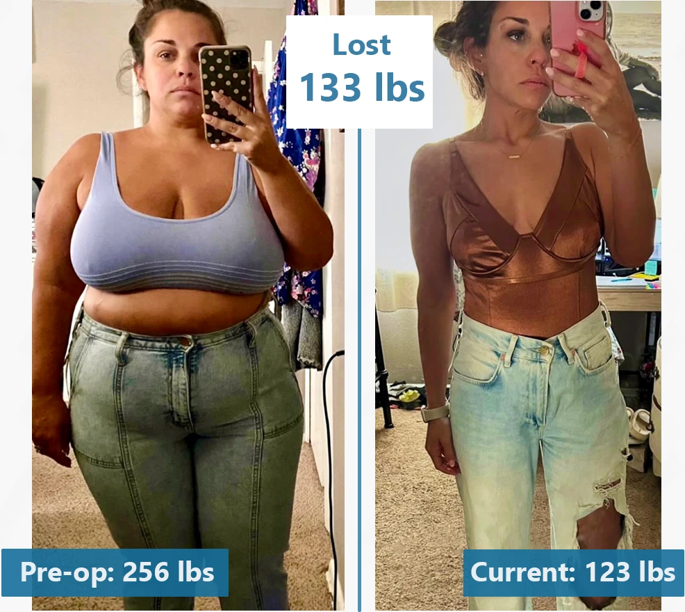 Before-and-after photographs of a BodEvolve patient, labeled 256 lbs before and 123 lbs after.